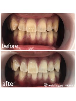ホワイトニングカフェ 岸和田店(WhiteningCafe)/プレミアム10回照射後