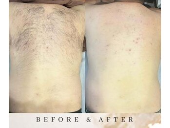 ゼロ アンド リセット(0ZERO&RESET)/【メンズ脱毛】0ZERO&RESET