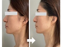 マグノリア/小顔パルス美容鍼