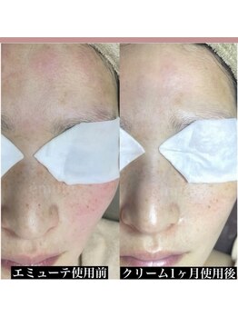 リュミエール デスポワール(Lumiere d'espoir)/ホームケア