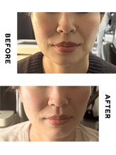 エリシオン(ELYSION)/RFリフトアップ