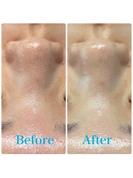 ティアーナ(Tiaana)/毛穴洗浄