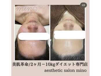 ミノ 美里大通り店(mino)/肌質改善