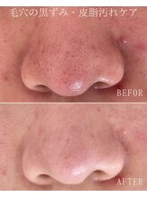 ココロ(COCORO)/毛穴洗浄 &nbsp;ビフォーアフター