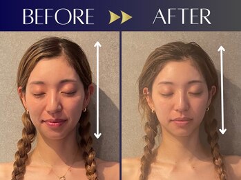 シンク(CINQ)/美容鍼灸60分1回の変化