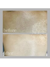 ダリア(DAHLIA)/徹底背中ケア14,000円～