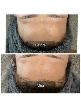 エヌ(enu)/毛穴洗浄/フェイシャル