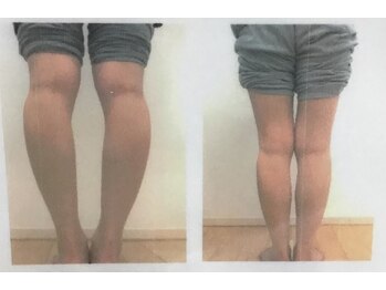 ゆあん(Yuan)/O脚矯正