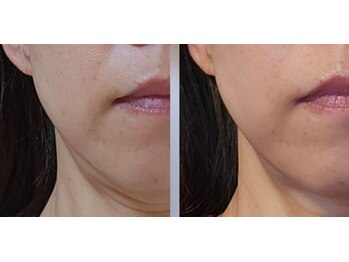 杏月(Kyozuki)/みんな続けたくなる!この変化☆