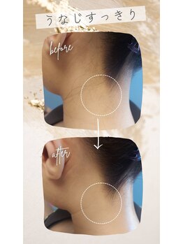 キアラ 麻布十番(Kiara)/麻布十番/毛穴/脱毛/顔脱毛