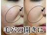 【開き毛穴】頬の毛穴の開き改善はこのコース！30代からの毛穴ケアに◎