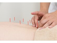 亀戸ソレイユ鍼灸整骨院/痛みの少ない優しい鍼