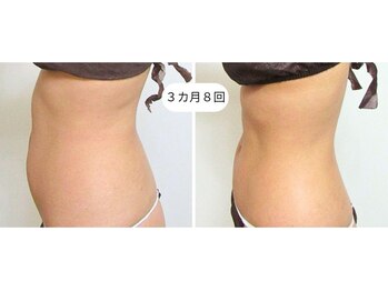 リクラ(Reclat)/モンテボディ 3カ月