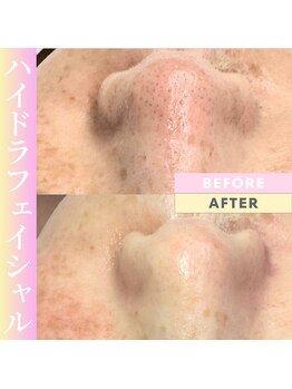 Cスキンケアクリニック 麻布店/毛穴洗浄ハイドラフェイシャル