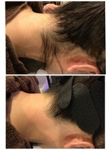 ビープラス(B plus)/効果長持ちうなじMIX脱毛☆