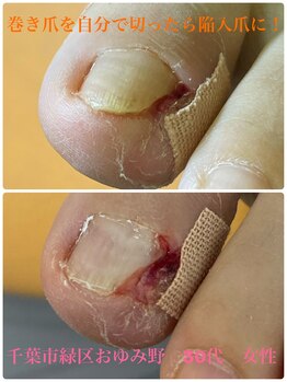 巻き爪じゅん 千葉駅前店/巻き爪自分で切ったら陥入爪に！