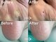 ディオフット(DIO FOOT)の写真/【累計5万人の施術実績!!】経験豊富な知識と確かな技術力で[巻き爪/分厚い爪]も改善◎