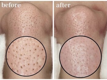 モテ 新宿店(Mote)/ハイドラ毛穴洗浄＋艶肌Wax 新宿