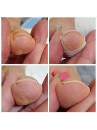 フットネイル巻き爪ケア