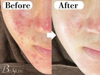 ビースキン 広島(BE:SKIN)/乳酸菌ピーリング/毛穴ケア