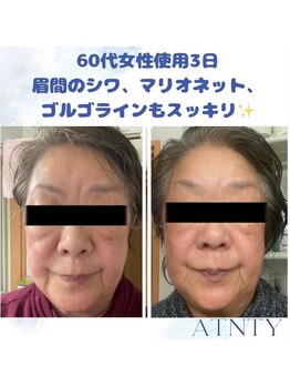 キワミ サーティスリー(kiwami33)/エステダーマ美容液導入