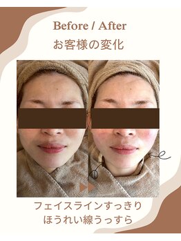 スリラ(SuriLa)/◆ビフォーアフター◆