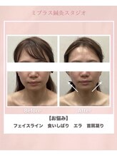 ミプラス鍼灸スタジオ/ビフォーアフター