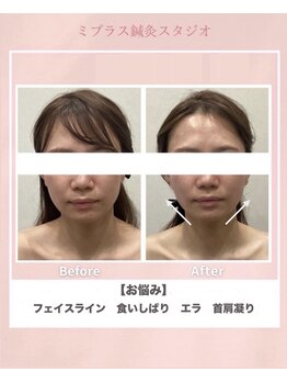 ミプラス鍼灸スタジオ/ビフォーアフター