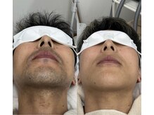 メリアミーゴ(Meli amigo)/【メンズ】足脱毛