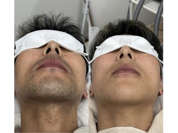 メリアミーゴ(Meli amigo)/【メンズ】足脱毛