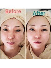 クラークハンド(KrarkHand)/施術例