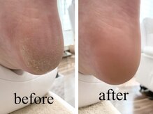 レア(Lea)/フット角質ケア☆★