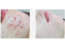 ビューティースパ/ニキビケア/お悩みのある方へ