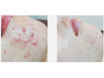 ビューティースパ/ニキビケア/お悩みのある方へ