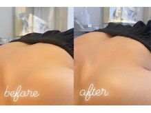 エムプリュ 心斎橋店(M.plus)/脂肪培養プレミアムコース1回目