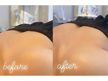 エムプリュ 心斎橋店(M.plus)/脂肪培養プレミアムコース1回目