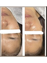 ナナラ(NANALA)/肩こりからくる、ほほの下がり…