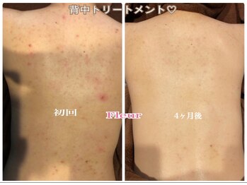 フルール(Fleur)/■背中トリートメント■