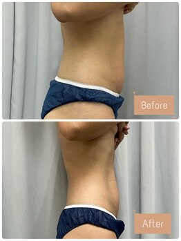 FJ/お腹周りのセル脂肪ケア!痩身