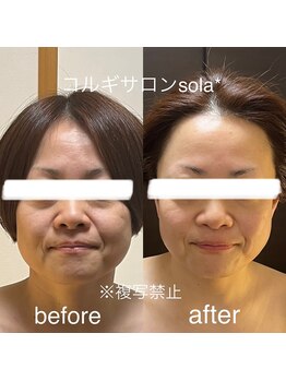 ソラ(sola*)/キュッとスッキリ小顔