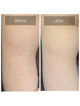 ルナート(Lunart)/ハーブピーリング【二の腕】