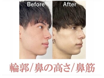 ラプリボーテ(Raplit BEAUTE)/隆鼻＋輪郭矯正40分30回