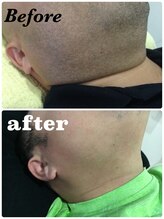 ひとつno武器/メンズ脱毛