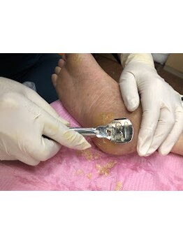 角質ケアができるサロン