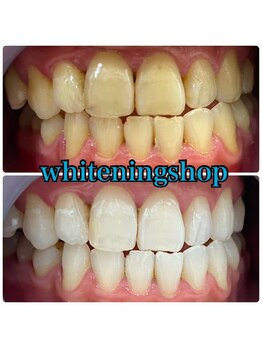 ホワイトニングショップ 吉祥寺店/BEFORE ＆ AFTER