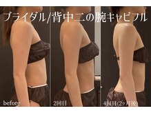 ハティア(hattia)/花嫁美容♪華奢な二の腕で挙式へ