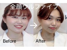 エステサロン ベルジュール/全顔(目元・頬・顎下・おでこ)