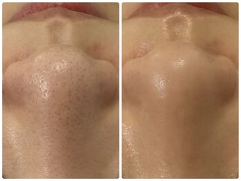 アリュール 京都烏丸御池店(ALLURE)の写真/《REVIハーブピーリング》5500円◆肌トラブルを根本的に改善!毛穴・ニキビケア◎1度で嬉しいぷるぷる肌♪