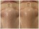 アリュール 京都烏丸御池店(ALLURE)の写真/《REVIハーブピーリング》5500円◆肌トラブルを根本的に改善!毛穴・ニキビケア◎1度で嬉しいぷるぷる肌♪