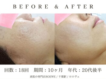 ロエヴェ(ROEWE)/ニキビ改善・毛穴ケア・肌質改善
